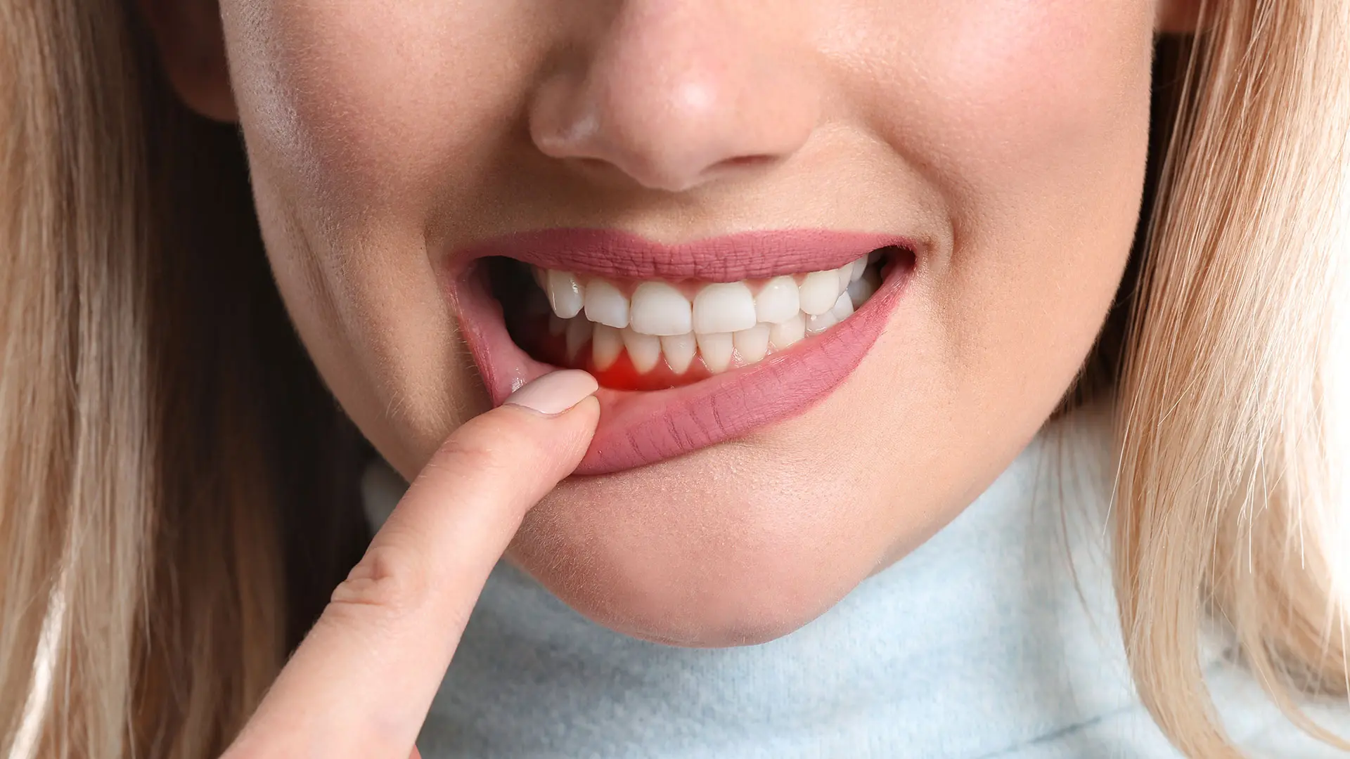 Junge Frau mit Parodontitis